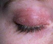Воспаление века глаза: симптомы и лечение