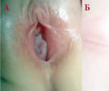 Особенности строения половых органов у детей Строение половых губ у девочек