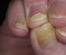 Определение болезней по ногтям рук